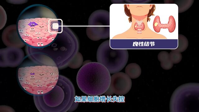 了解甲状腺癌,这一篇就够了!权威医学大咖讲透甲状腺癌丨奇点深度