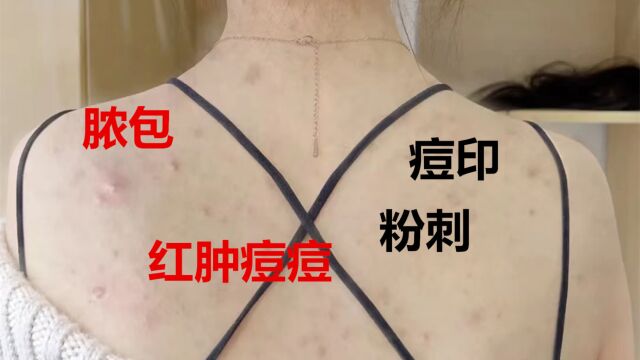 身上经常发痒还爆痘!原来是螨虫在作祟!学会这招洗洗就能拥有光滑肌肤!