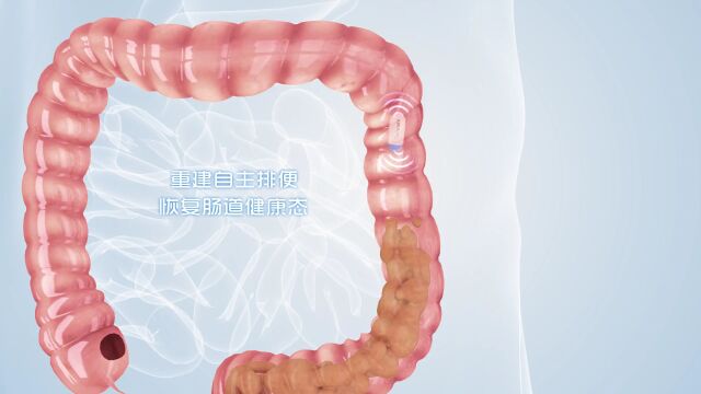 便秘人士有福了!高科技振动胶囊加速临床应用普及