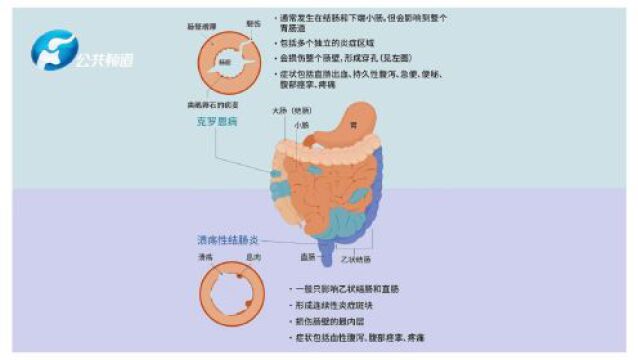 报道 | 理论与实践并重!“炎症性肠病诊疗专科培训公益项目—郑州站”成功举办