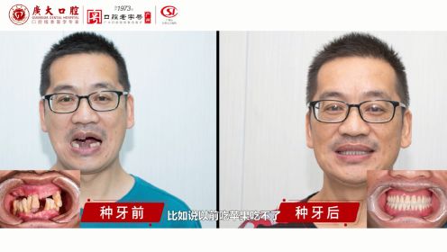广州种植牙案例分享——49岁杨先生全口牙齿缺失松动，全口种植修复后恢复咀嚼和美观！