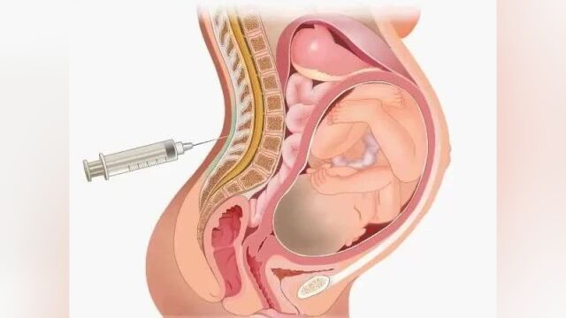 动画演示什么是腹膜内剖宫产手术