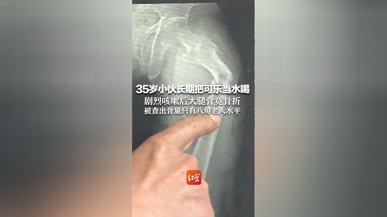 35岁小伙长期把可乐当水喝,剧烈咳嗽后大腿骨竟骨折